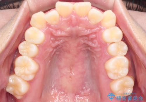 【インビザライン】笑ったときに目立つ八重歯をなおしたいの治療前