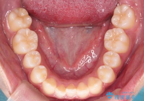 【インビザライン】笑ったときに目立つ八重歯をなおしたいの治療前