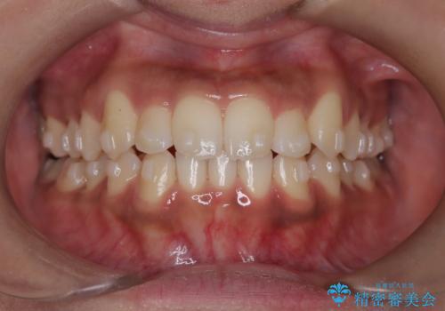 【インビザライン】笑ったときに目立つ八重歯をなおしたいの治療中