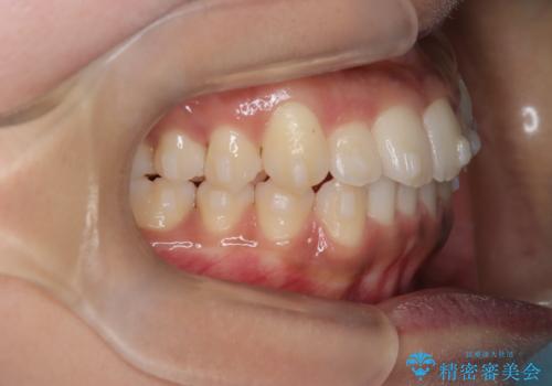 【インビザライン】笑ったときに目立つ八重歯をなおしたいの治療中