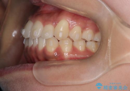 【インビザライン】笑ったときに目立つ八重歯をなおしたいの治療中