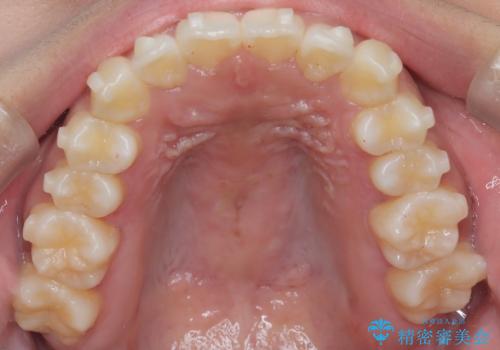 【インビザライン】笑ったときに目立つ八重歯をなおしたいの治療中