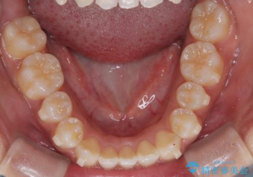 【インビザライン】笑ったときに目立つ八重歯をなおしたいの治療中