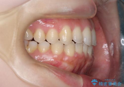 【オープンバイト】前歯のがたがたをなおしたい。の治療後
