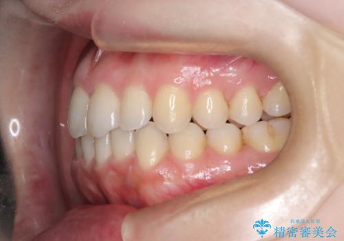 【オープンバイト】前歯のがたがたをなおしたい。の治療後