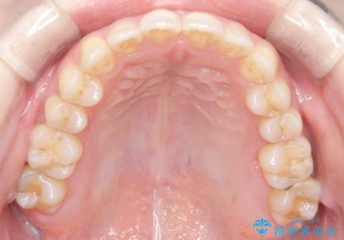【オープンバイト】前歯のがたがたをなおしたい。の治療後
