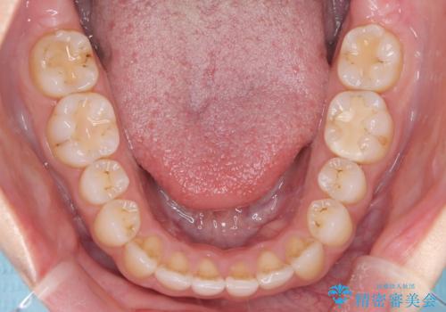 【オープンバイト】前歯のがたがたをなおしたい。の治療後