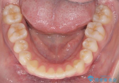 【ワイヤー矯正】前歯の真ん中を合わせたい。の治療後