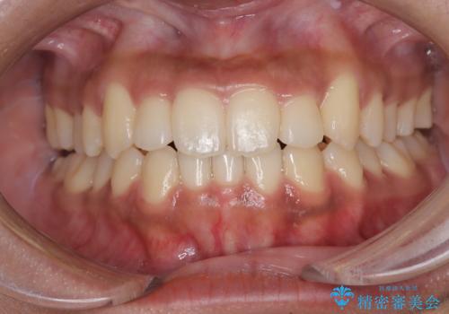 【インビザライン】笑ったときに目立つ八重歯をなおしたいの治療後