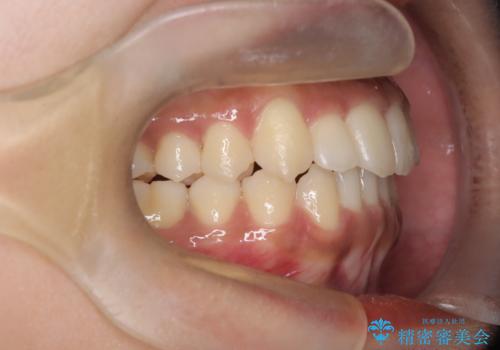 【インビザライン】八重歯をなおしたいの治療後