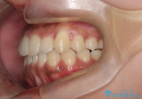 【インビザライン】笑ったときに目立つ八重歯をなおしたいの治療後