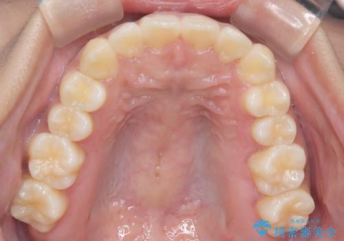 【インビザライン】笑ったときに目立つ八重歯をなおしたいの治療後