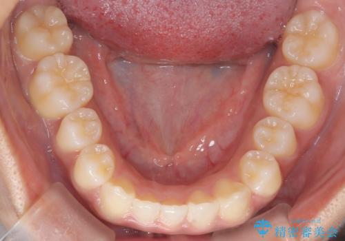 【インビザライン】笑ったときに目立つ八重歯をなおしたいの治療後