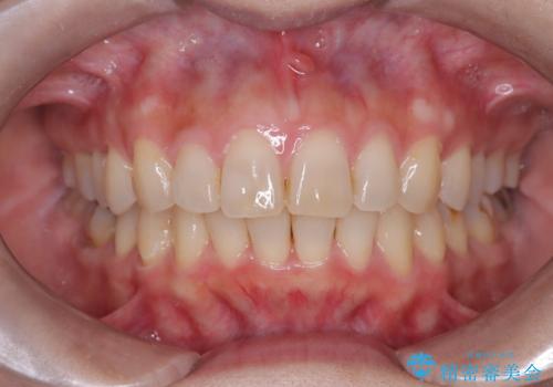 【インビザライン】前歯の凸凹を治したい