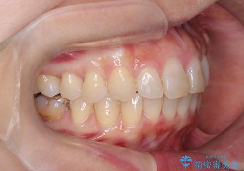 【インビザライン】前歯の凸凹を治したいの治療後
