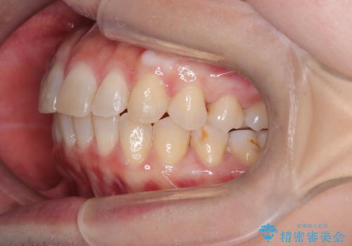 【インビザライン】前歯の凸凹を治したいの治療後