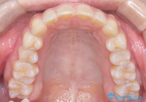 【インビザライン】前歯の凸凹を治したいの治療後