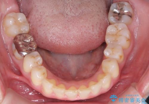 【インビザライン】前歯の凸凹を治したいの治療後