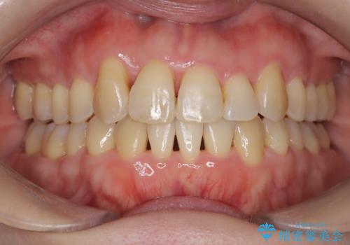 【インビザライン】ずれた前歯の噛み合わせをなおしたいの治療後