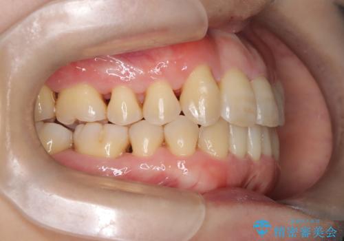 【インビザライン】ずれた前歯の噛み合わせをなおしたいの治療後