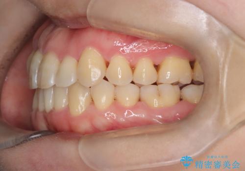 【インビザライン】ずれた前歯の噛み合わせをなおしたいの治療後