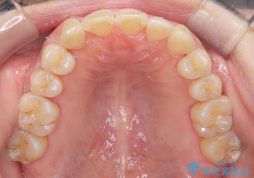 【インビザライン】ずれた前歯の噛み合わせをなおしたいの治療後