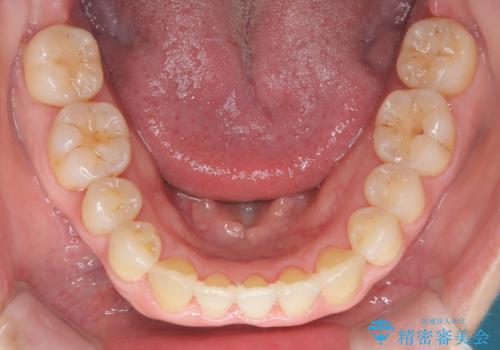 【インビザライン】ずれた前歯の噛み合わせをなおしたいの治療後