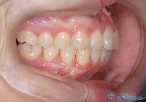 【ワイヤー矯正】前歯の真ん中を合わせたい。の治療後