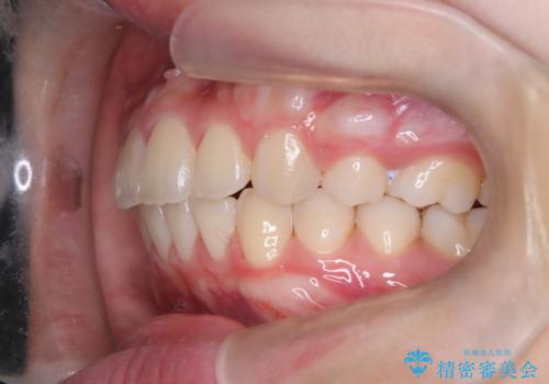 【ワイヤー矯正】前歯の真ん中を合わせたい。の治療後