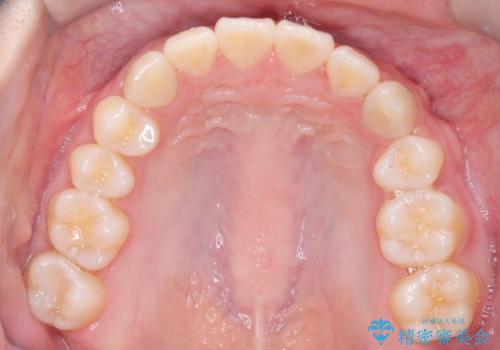 【ワイヤー矯正】前歯の真ん中を合わせたい。の治療後