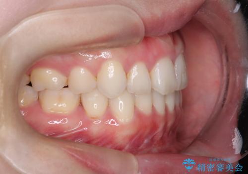 【抜歯インビザ】前歯の凸凹をなおしたいの治療後