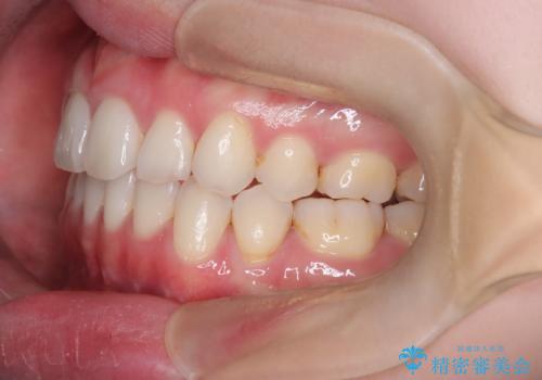 【抜歯インビザ】前歯の凸凹をなおしたいの治療後