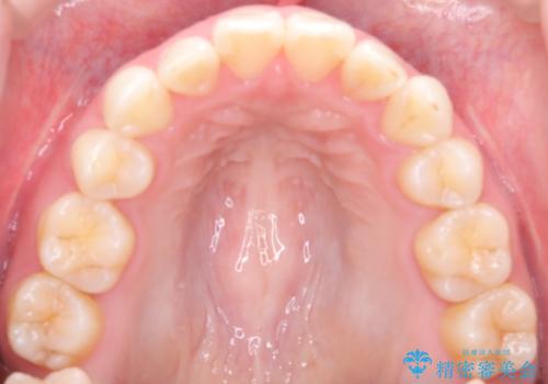【抜歯インビザ】前歯の凸凹をなおしたいの治療後