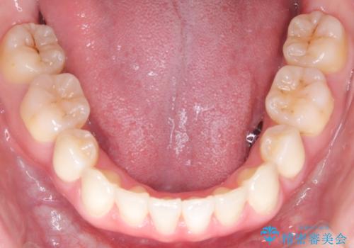 【抜歯インビザ】前歯の凸凹をなおしたいの治療後