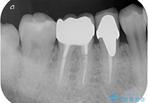 目立つ銀歯を白くしたい ジルコニアクラウンでの修復の治療後