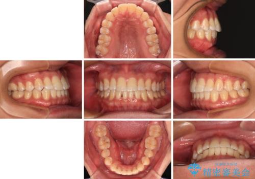 【モニター】楽して治したい メタルブラケットによる矯正治療の治療後