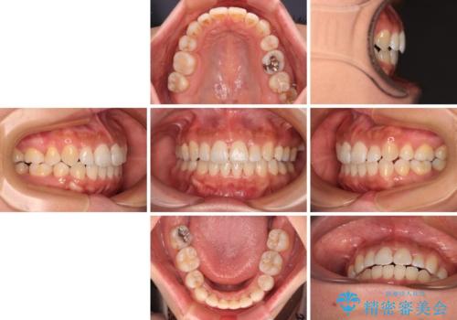 既に2本が抜歯されている歯列 咬み合わせのズレを改善する抜歯矯正の治療後