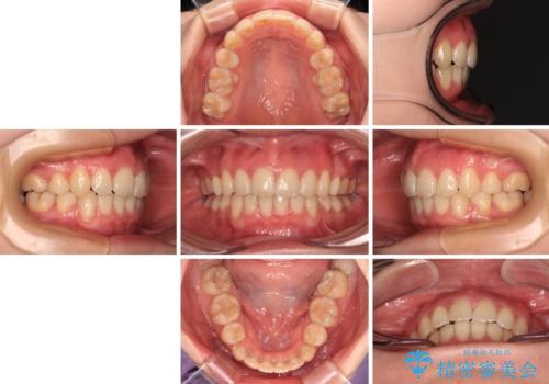 【モニター】横顔のシルエットをスッキリと ワイヤー装置による抜歯矯正治療の治療後