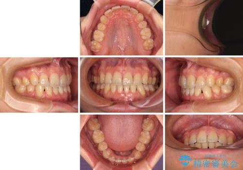 出っ歯と八重歯 目立たない裏側装置でスッキリとした口元にの治療後