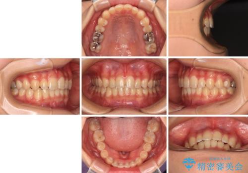 深い咬み合わせとデコボコの歯列をワイヤー矯正で改善の治療後