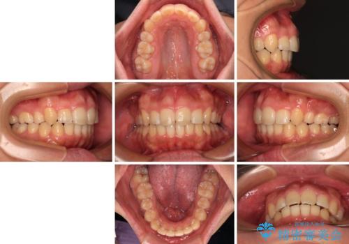 【モニター】後戻りで飛び出してきた前歯 ワイヤー装置での再矯正の治療後
