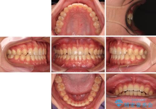 空隙歯列を閉じる 舌のトレーニングとワイヤー矯正の治療後