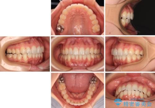 【モニター】前歯のデコボコをインビザラインで改善の治療後