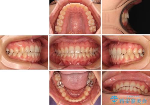 前歯のクロスバイト インビザラインによる矯正治療の治療後