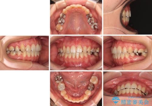 インビザラインが続けられない 装置変更して抜歯矯正の治療後