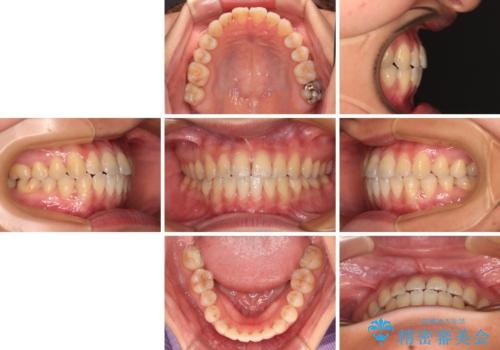 前歯のクロスバイトを治したい ワイヤー装置による矯正治療の治療後