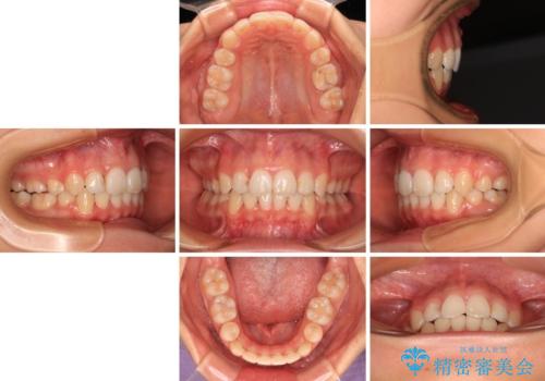 八重歯と乱れた咬み合わせを改善 ワイヤー装置での抜歯矯正の治療後
