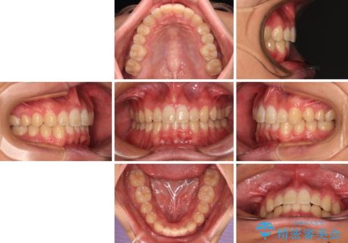 欠損した前歯とディープバイト ワイヤー矯正で短期間で治療の治療後