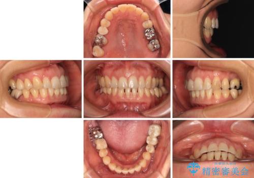 正中のズレと飛び出した前歯を改善 メタルブラケットでの抜歯矯正の治療後