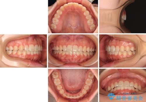 前歯のデコボコを整える インビザラインによる矯正治療の治療後